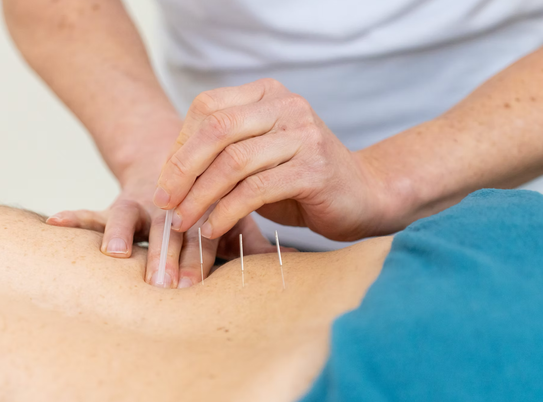 Acupuncture